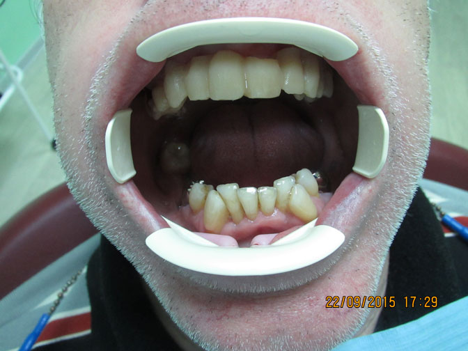 Фото протезирования зубов до начала