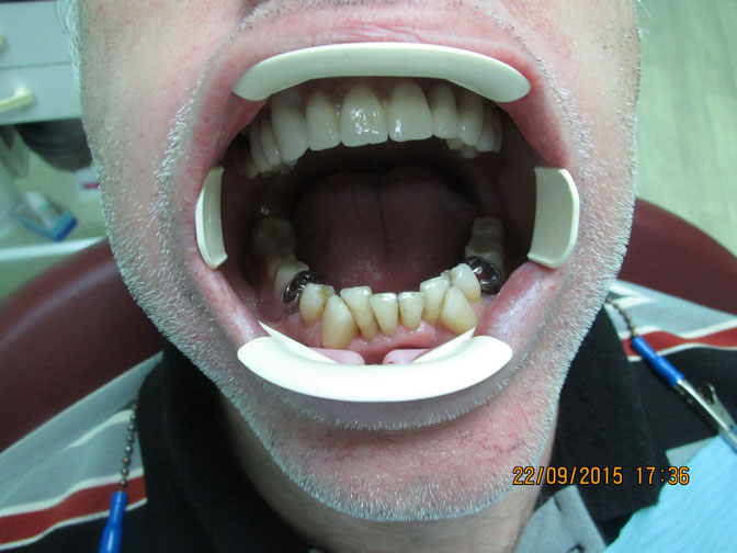 Фото протезирования зубов