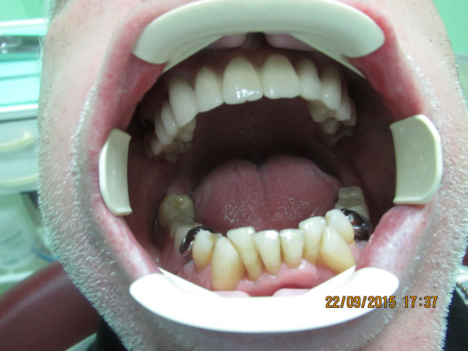 Фото протезирования зубов